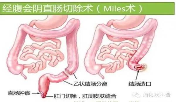 新辅助化疗是什么意思
