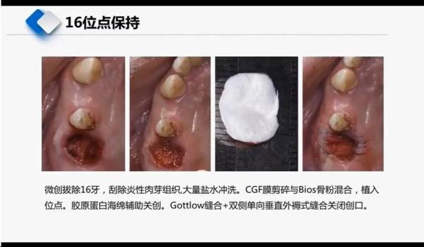 拔智齿的时候嘴巴有辅助吗
